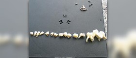 Painful teeth problem