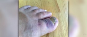 Painful toenail