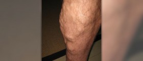 Painful varicose veins