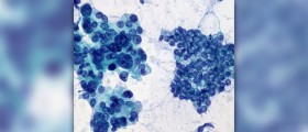 Pancreatic cancer surgery