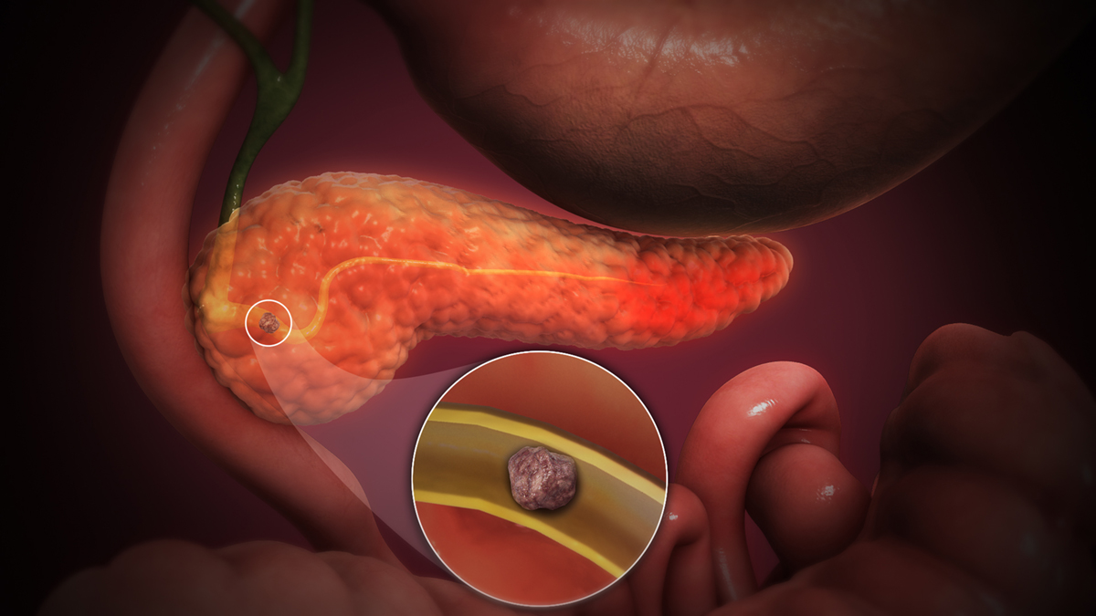 Causes of pancreatitis | General center | SteadyHealth.com