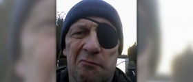 Paralysis of the face