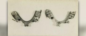 Partial dentures cost