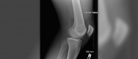 Patella femoral syndrome