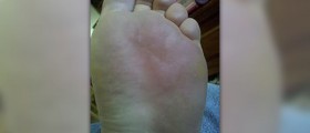 Peeling feet remedies