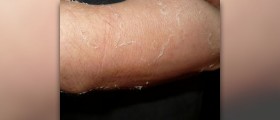 Peeling skin facts
