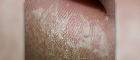 Peeling skin on fingers