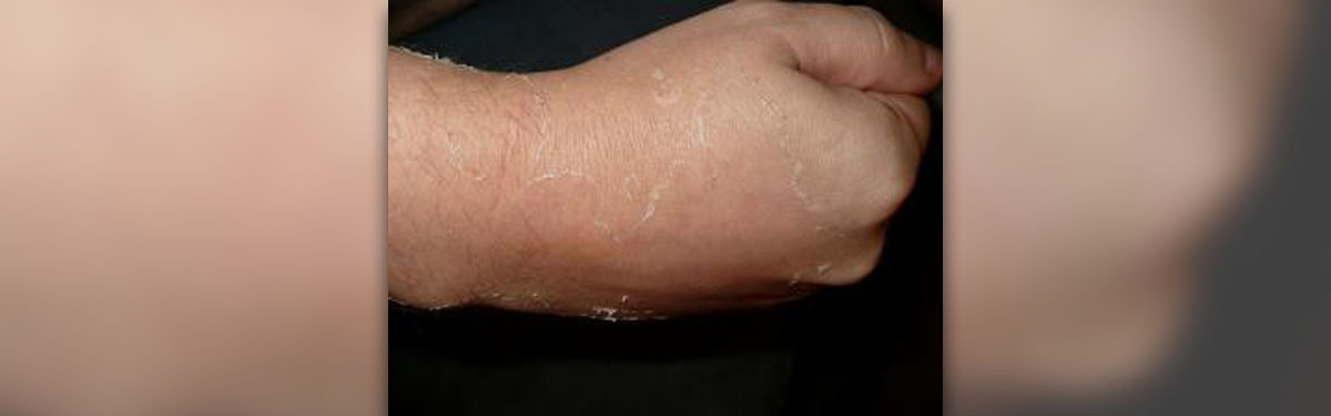 Peeling Skin On Hands General Center Steadyhealthcom