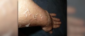 Peeling sunburn skin