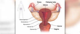 Chronic pelvic inflammatory disease