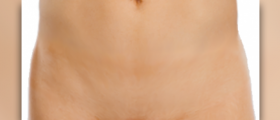 What is pelvic organ prolapse?