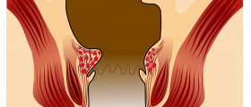 Pregnancy hemorrhoids