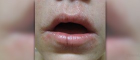 Perioral dermatitis in kids