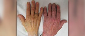 Pernicious anemia facts