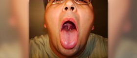 Persistent sore throat