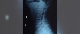 Pinched nerve symptoms