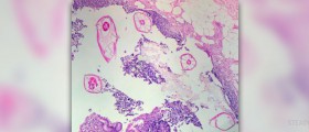 Pinworms in children review