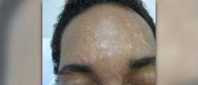 Pityriasis rosea treatment - Get skin relief now