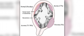 Placenta accreta - what it is and how it is diagnosed