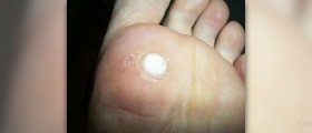 Plantar fascia rupture
