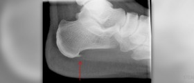 Plantar fasciitis treatment