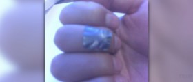 Plantar warts and duct tape