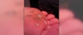 Plantar warts on feet