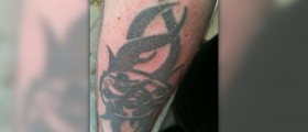 Plastic surgery for tattoo removal