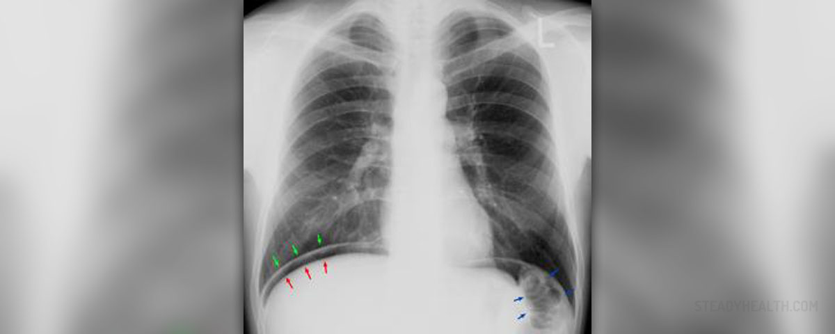 pneumonia-recovery-time-respiratory-tract-disorders-and-diseases