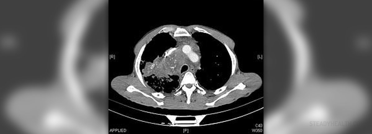 pneumonia-symptoms-and-back-pain-general-center-steadyhealth