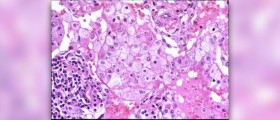 Pneumonia symptoms in children