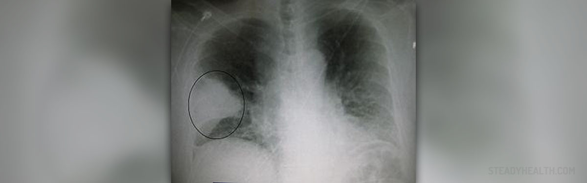 Pneumonic plague and bubonic plague | Respiratory tract disorders and