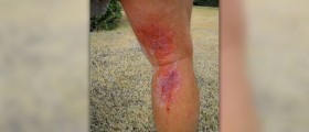 Poison oak symptoms