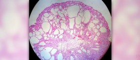 Polyps in stomach