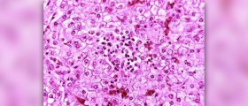 Possible causes of Reye's syndrome and correlation with aspirin