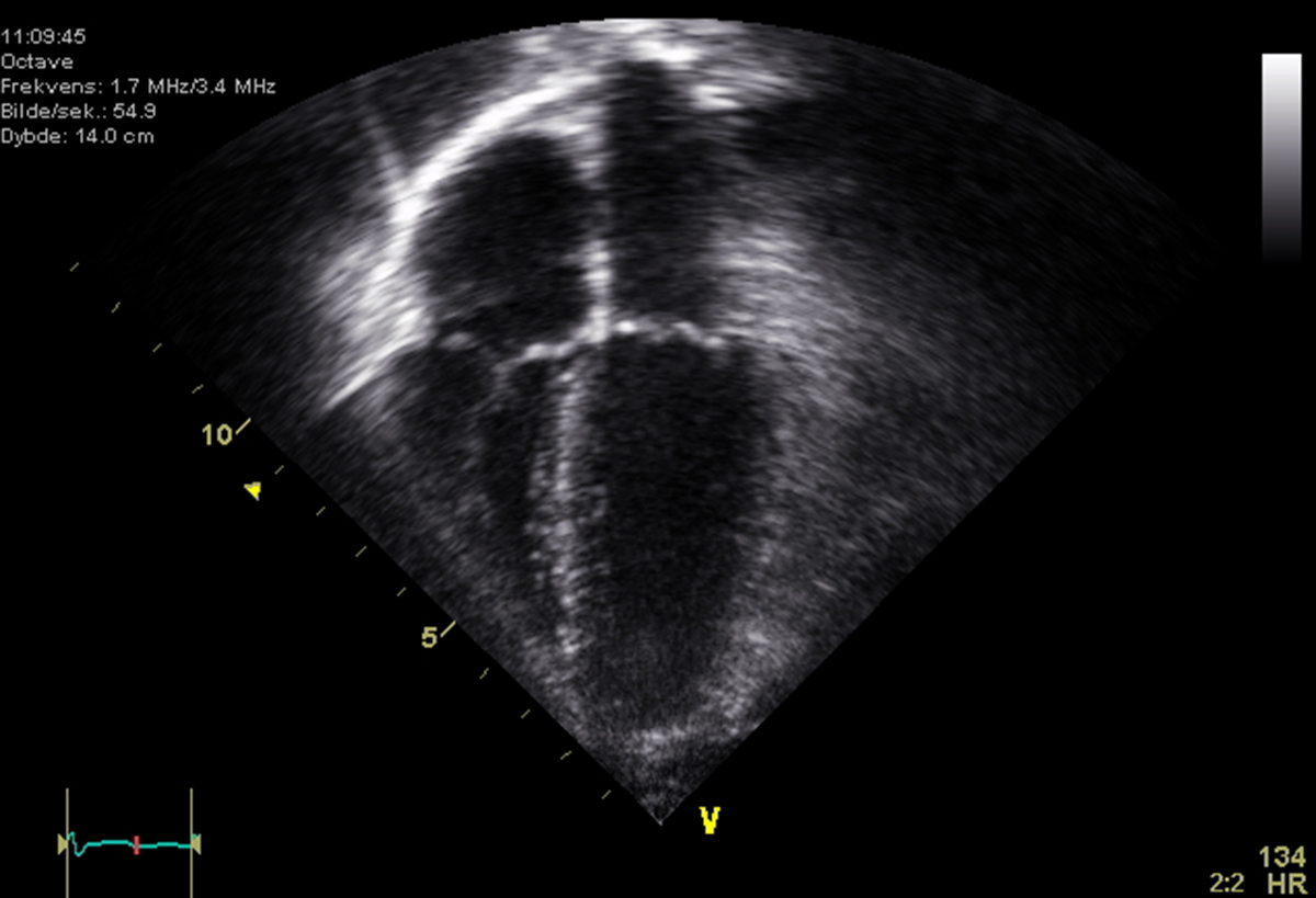 possible-complications-of-transesophageal-echocardiogram-therapies