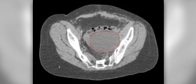 What are lymphocele symptoms