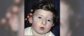 Prader-Willi syndrome lifestyle changes