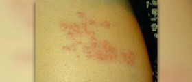 Precautions for shingles