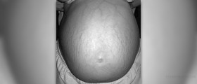 Pregnancy stretch marks