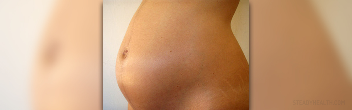 pregnancy stretch marks