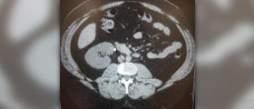 Preventing kidney stones