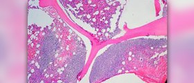 Prevention of bone cancer