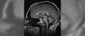 Prevention of brain cancer