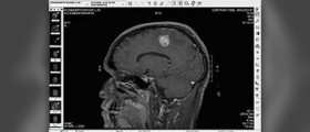 Prevention of brain tumors