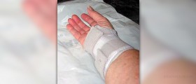 Prevention of carpal tunnel syndrome