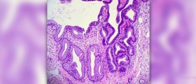 Prevention of cervical cancer