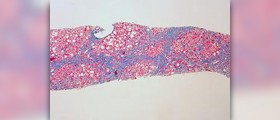 Prevention of cirrhosis of liver