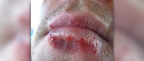 Prevention of cold sores