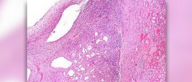 Prevention of cystic fibrosis
